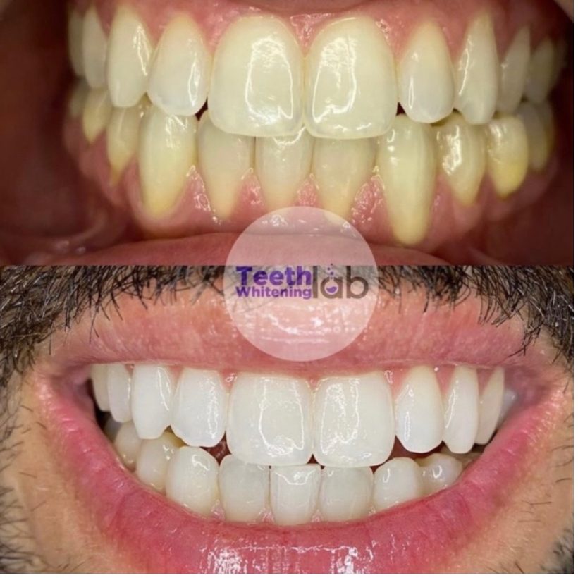Before and after whitening result