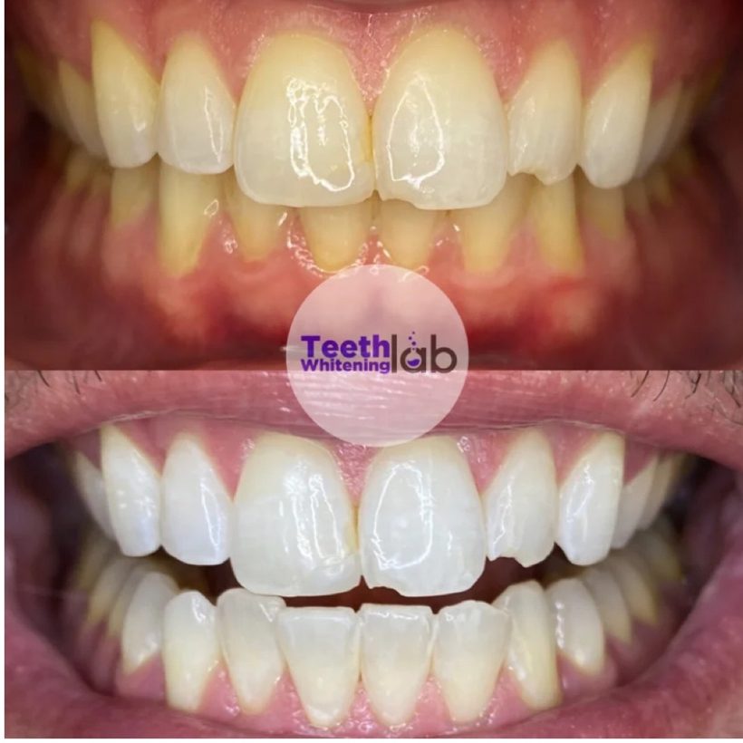 Before and after whitening result