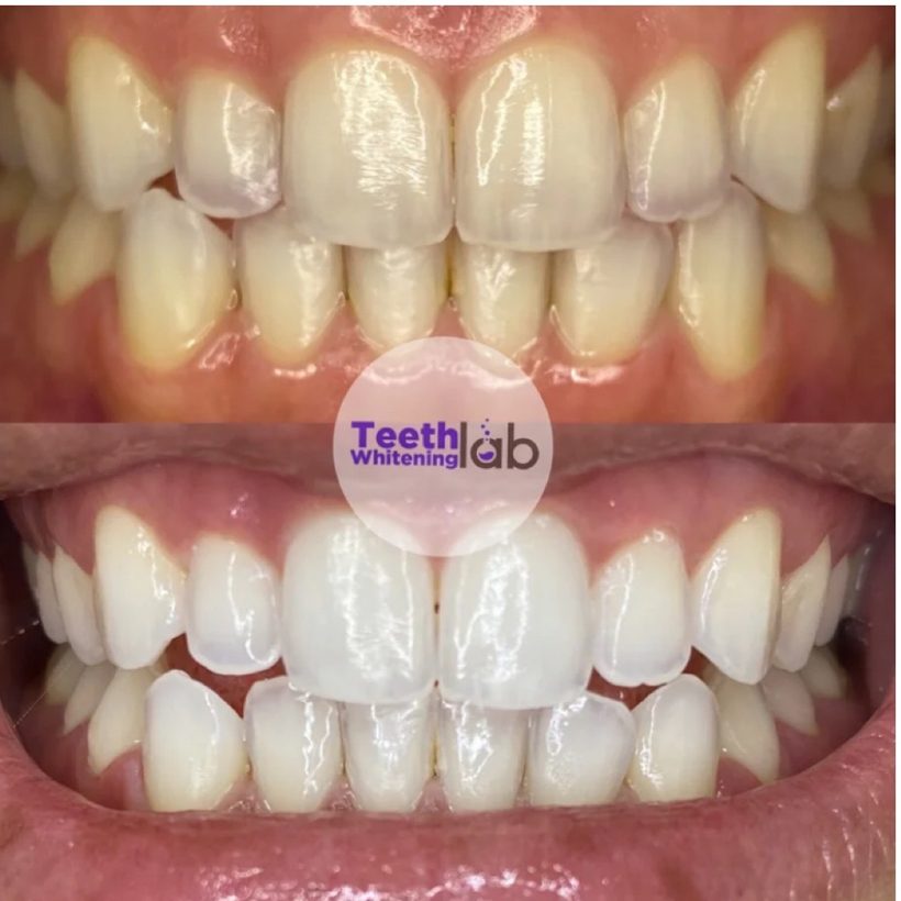Before and after whitening result