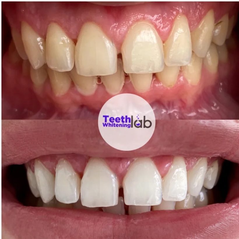 Before and after whitening result