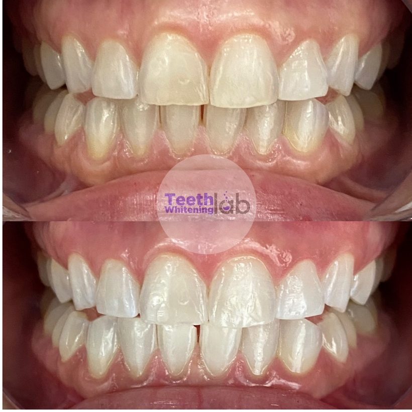 Before and after whitening result