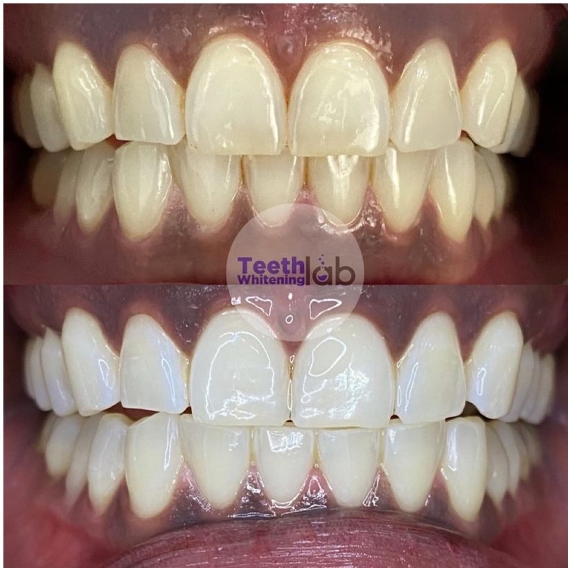 Before and after whitening result