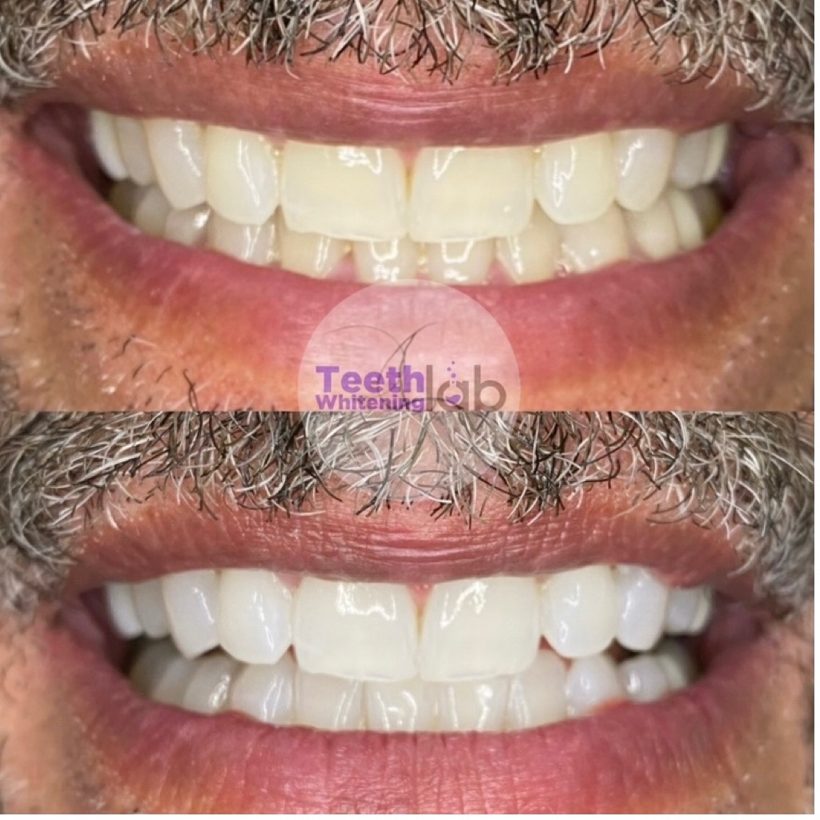 Before and after whitening result
