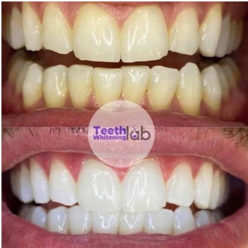 Before and after whitening result