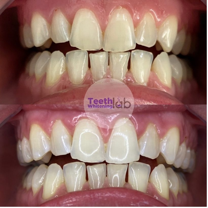 Before and after whitening result