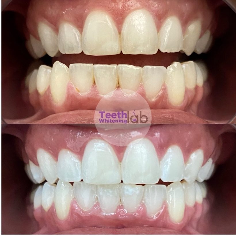 Before and after whitening result