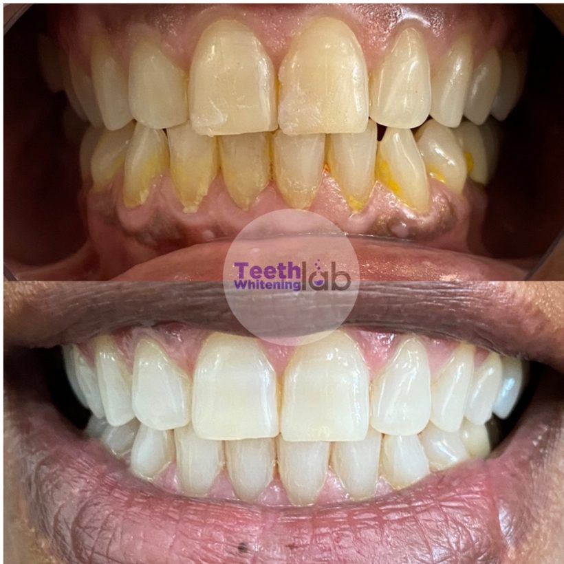 Before and after whitening result