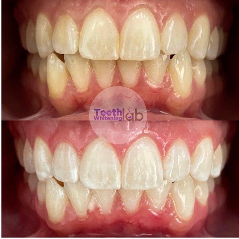 Before and after whitening result