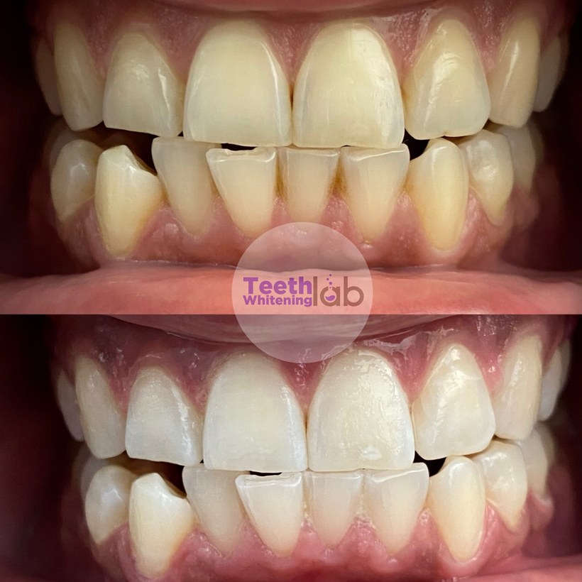 Before and after whitening result