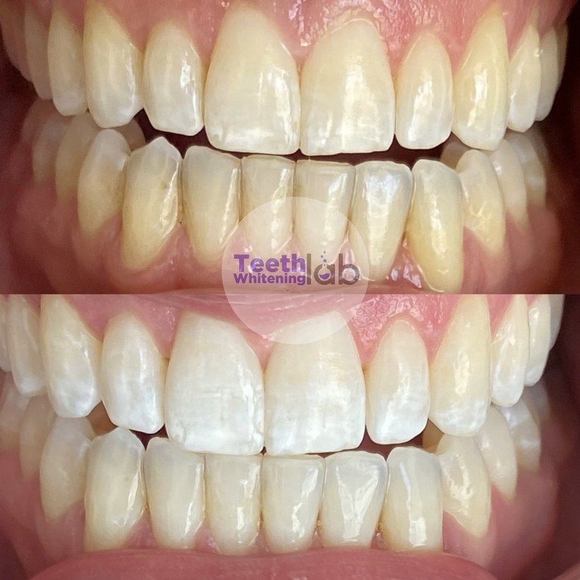 Before and after whitening result