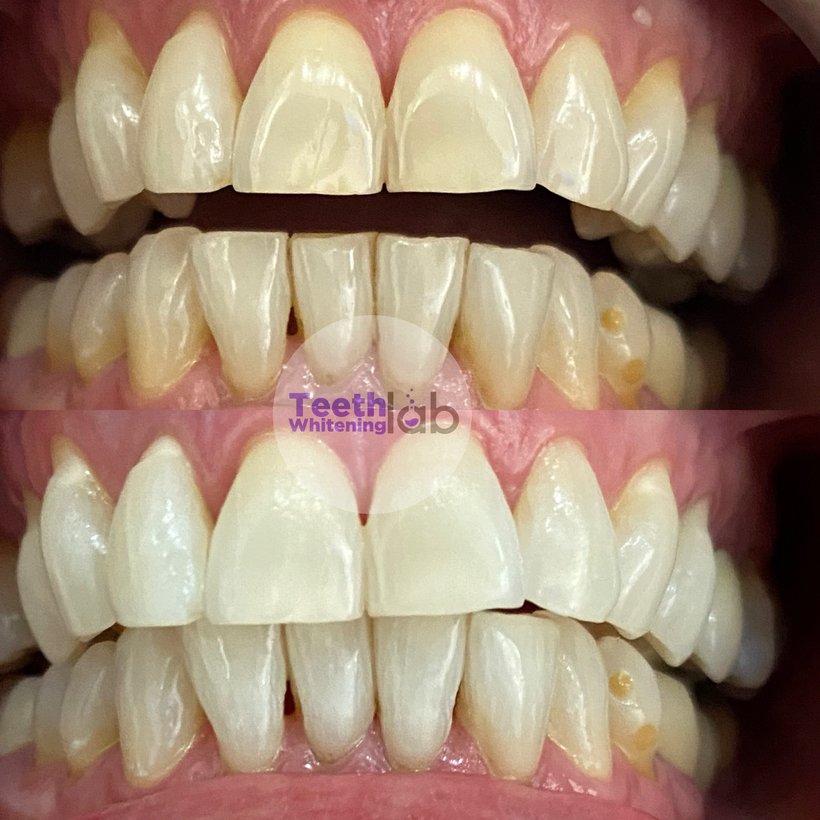Before and after whitening result