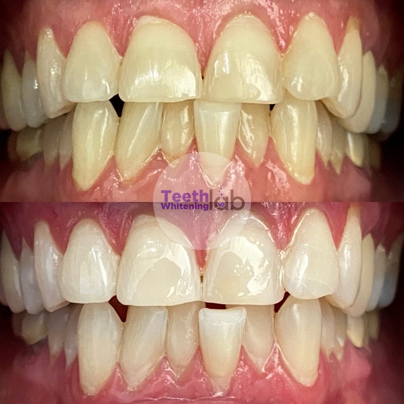 Before and after whitening result